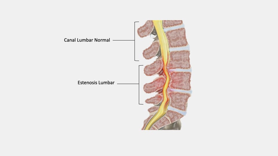 Estenosis de columna lumbar - NeuroCS