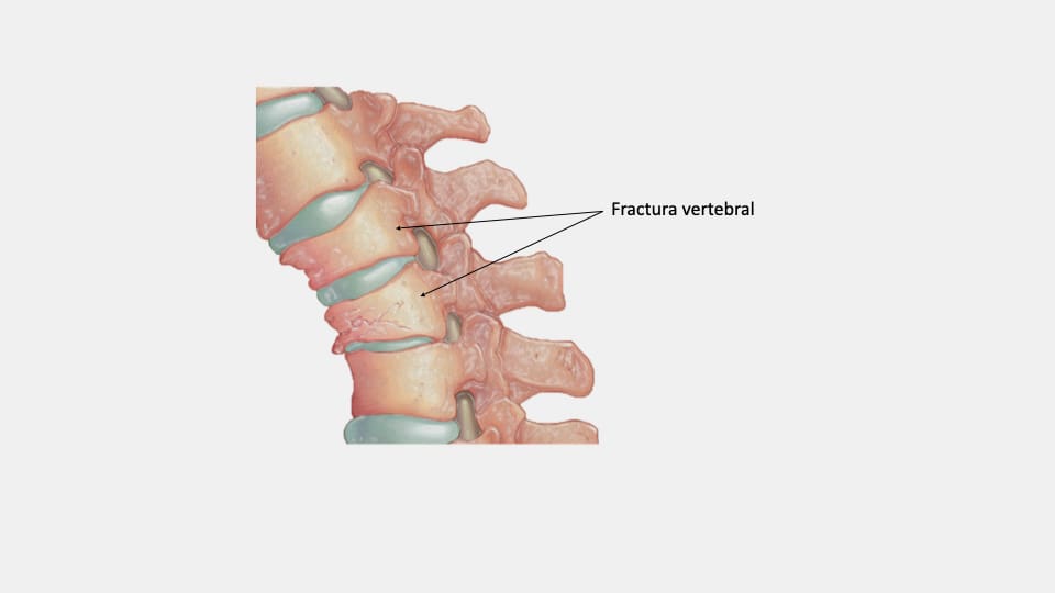 vertebral - NeuroCS