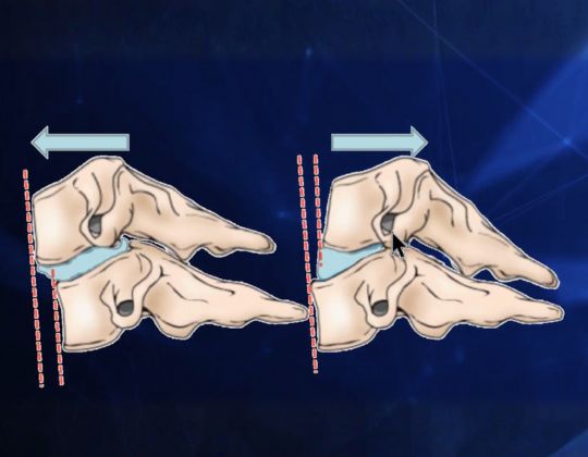 Inestabilidad de columna