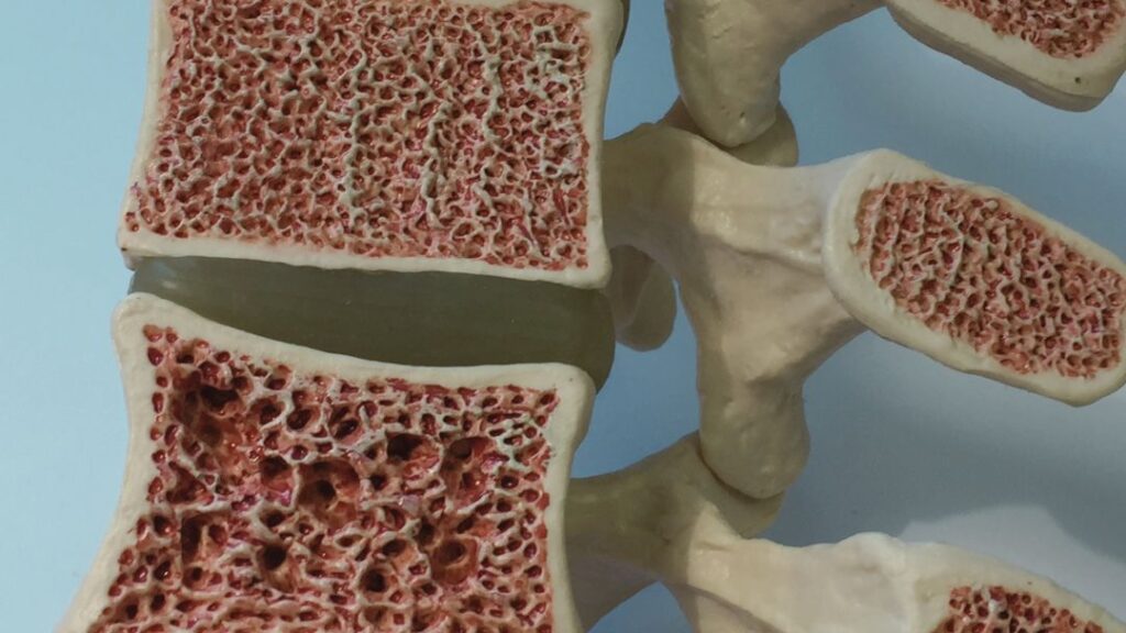Factores que influyen en la pérdida de hueso Factores que influyen en la pérdida de hueso: columna vertebral con diferentes estados de osteoporosis. Name: Factores que influyen en la pérdida de hueso