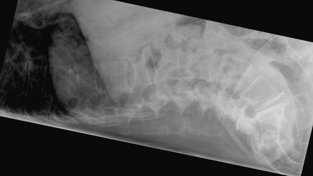 Fractura vertebral por osteoporosis Fractura vertebral por osteoporosis